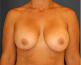 Feel Beautiful - Breast Implant Removal 200 - Before Photo
